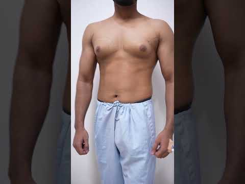 Transforming Gynecomastia Treatment with Innovative Solutions