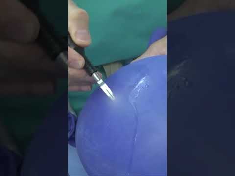 Laminectomy Innovations: Revolutionizing Spine Surgery Today