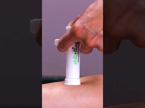 Say Goodbye to Itchy Insect Bites with Smart Relief Tech