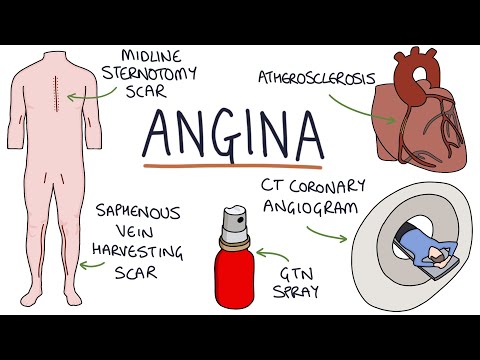 Understanding Angina Meaning in Health and Technology Insights