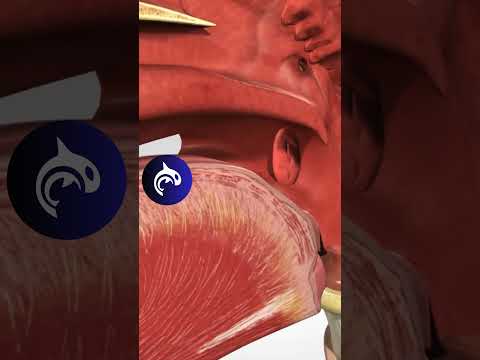Strep Throat Tech: Tackling Infection Without Tonsils