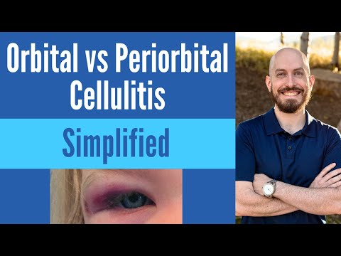 Unlocking Innovation in Peri Optical Cellulitis Solutions