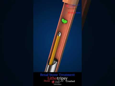 Conquering Kidney Stones with Innovative Tech Solutions