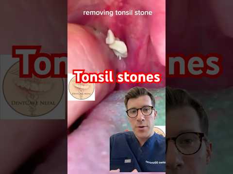 Uncovering the Truth Behind Throat White Spots and Tech Solutions
