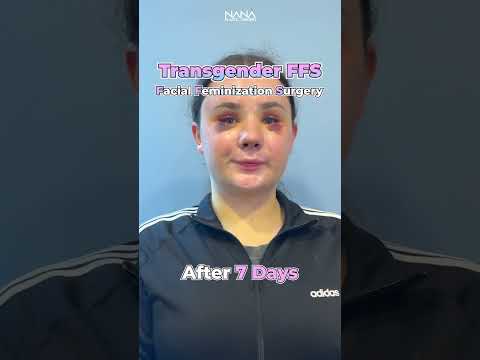 Transforming Futures: MTF Bottom Surgery Innovations