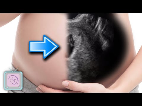 Unlocking Early Pregnancy with Advanced Gestational Sac Tech