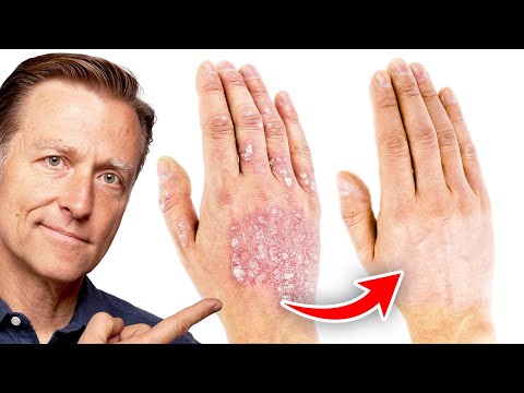 Soothe Eczema Around Your Mouth with Innovative Solutions