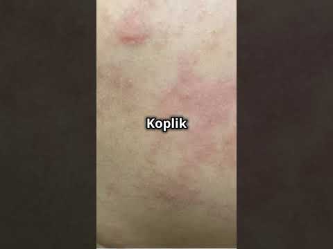 Measles Transmission Uncovered: The Tech Behind the Spread