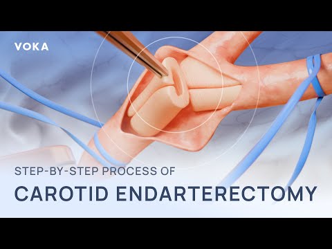 Revitalize Health with Advanced Carotid Endarterectomy Tech