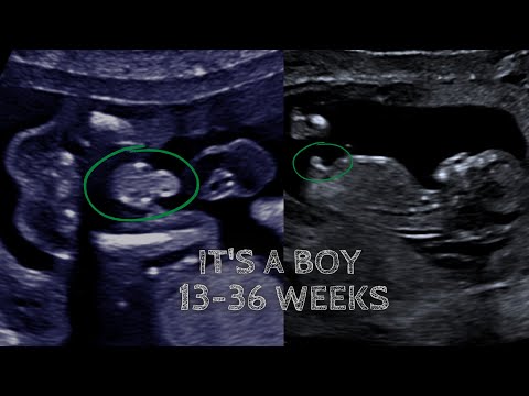 13 Week Ultrasound: Technology Unveiling Your Baby's Journey
