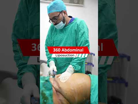 Transform Your Look: Lipo Before and After Results