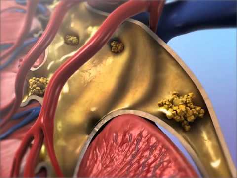Kidney Stones Uncovered: Understand Their Technology and Causes