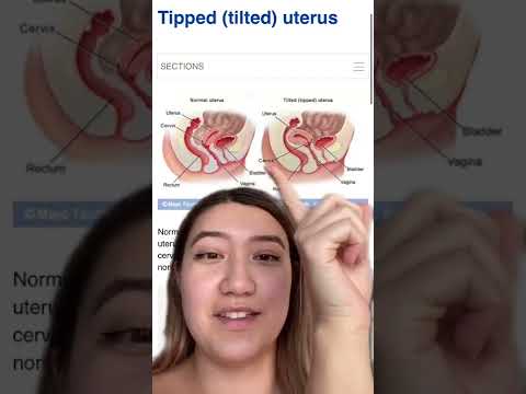 Embrace Your Unique Journey with Retroverted Uterus Pregnancy