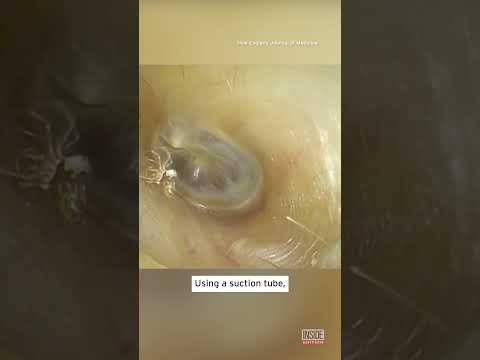 Relief at Your Fingertips: Innovative Itchy Ear Drops