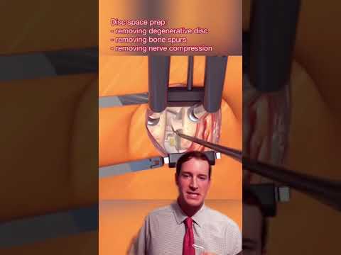 Unlocking the Potential of ACDF in Modern Marketing Strategies