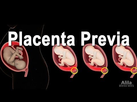 Recognize the Signs of Placenta Previa Early and Stay Safe