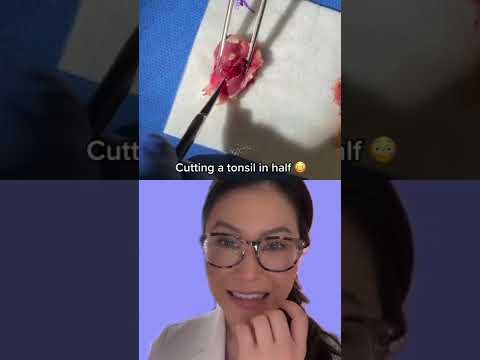 Tonsil Stone Breakthrough: Innovative Solutions for Relief
