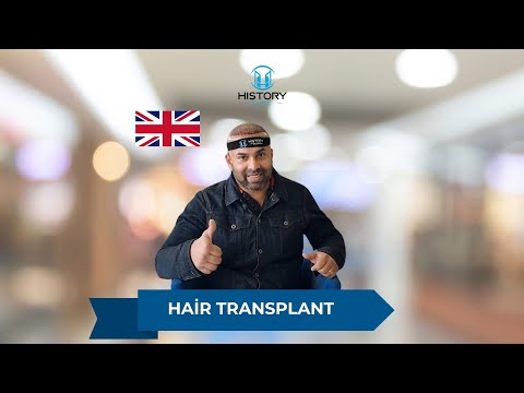 Local Hair Transplants Redefined by Cutting-Edge Technology