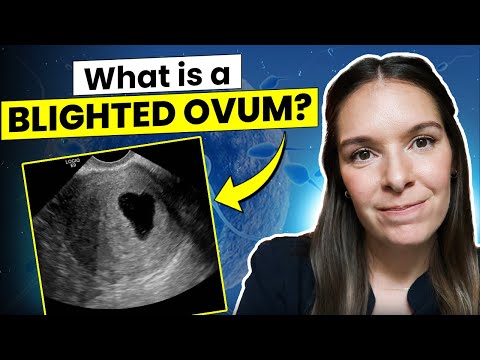 Understanding Blighted Ovum: Innovations in Reproductive Health