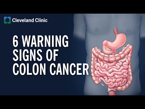 Understanding Colon Cancer Stages for Better Outcomes