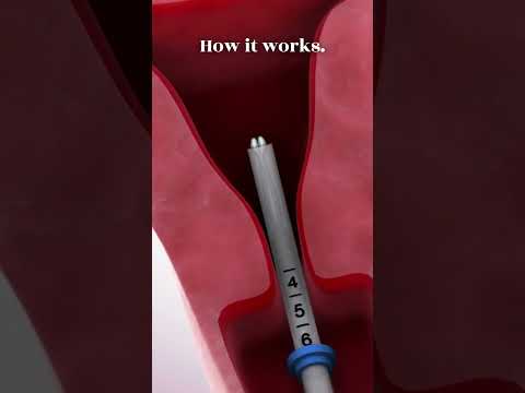 Kyleena IUD: Empowering Women with Smart Birth Control Solutions