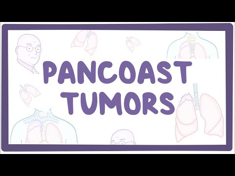 Unraveling Pancoast Tumors with Cutting-Edge Technology