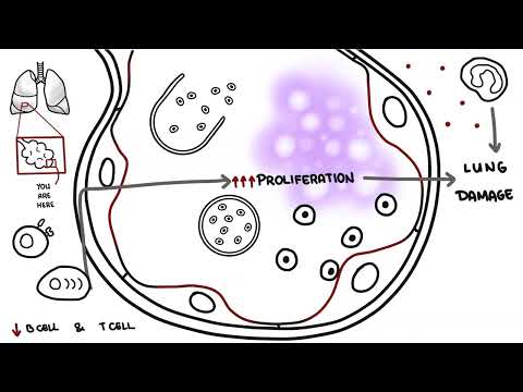 Innovative Solutions for Pneumocystis Jiroveci Pneumonia Care
