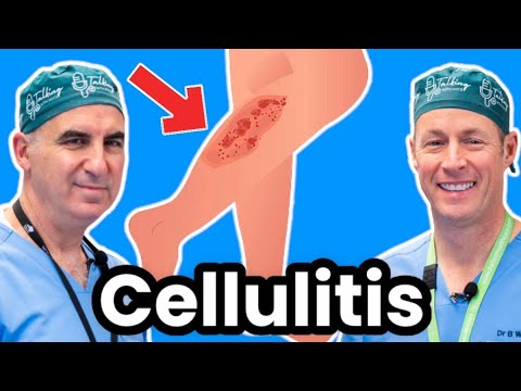 Understanding Cellulitis: What You Need to Know Now