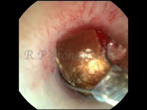 Revolutionary Tech for Stress-Free Kidney Stone Surgery