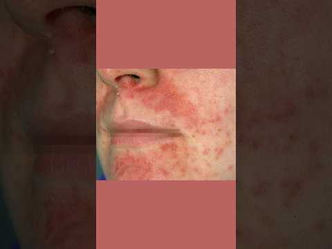 Say Goodbye to Mouth Dermatitis with Innovative Solutions