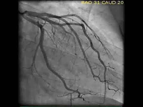 Revolutionizing Heart Health with Coronary Angiograms