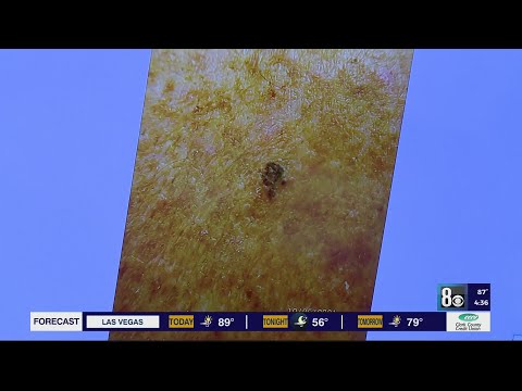 Shield Your Scalp: Tech Solutions Against Skin Cancer Risks