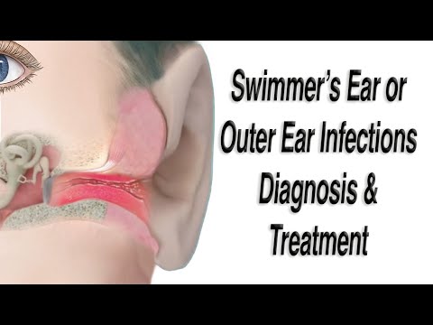 Transforming Ear Health: Innovations in Treating External Otitis Media