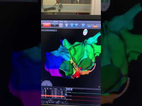 Revolutionizing Heart Care: Tackling PVC Arrhythmia with Tech
