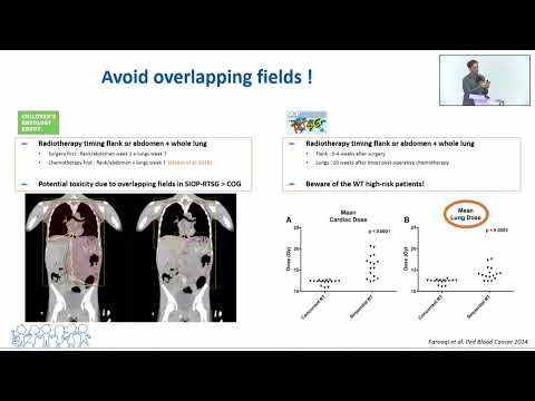 Innovative Solutions for Wilms Tumor Treatment Advances