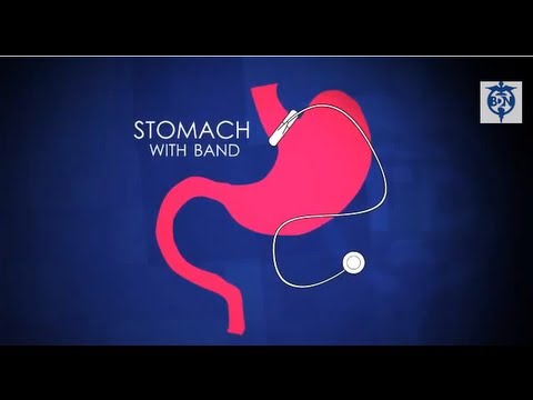 Revolutionize Weight Loss with Innovative Lap Band Surgery
