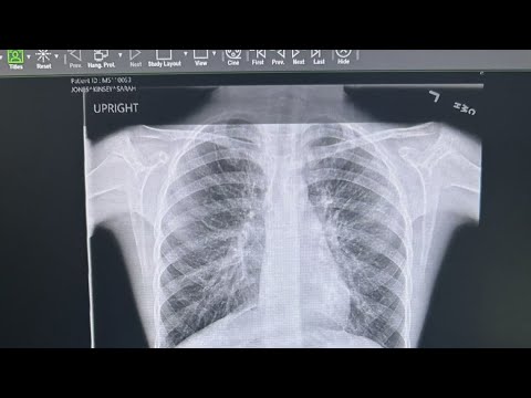 Unmasking Mycoplasma Pneumonia Symptoms for Better Health Insights