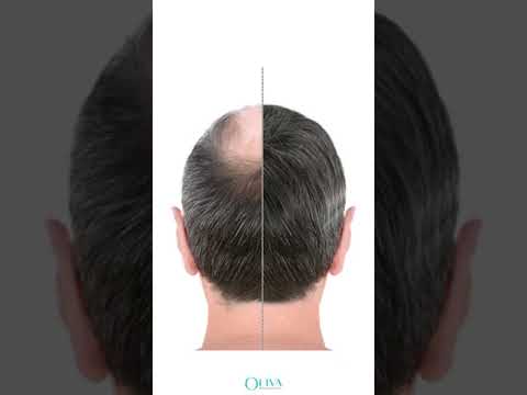 Stress and Hair Loss: A Tech-Savvy Solution Awaits