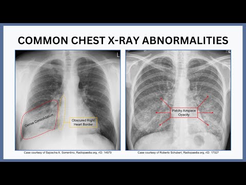 Advanced Chest X-Ray Technology for Pneumonia Detection
