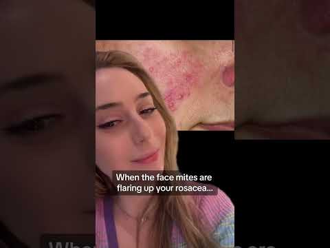 Revitalize Your Skin with the Latest Rosacea Cream Innovation