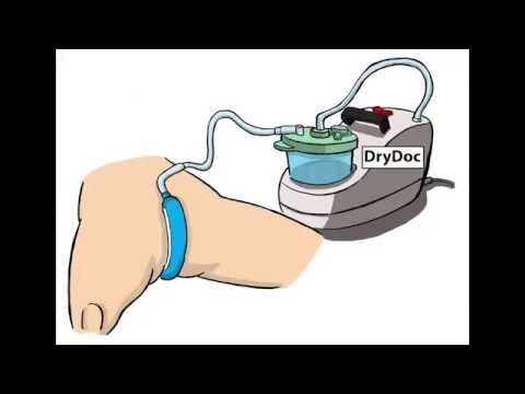 Revolutionize Care with PureWick Catheter Technology