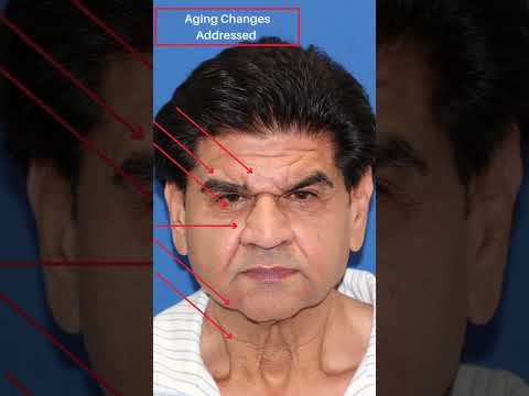 Revitalize Your Look: The Future of Rhytidectomy Technology