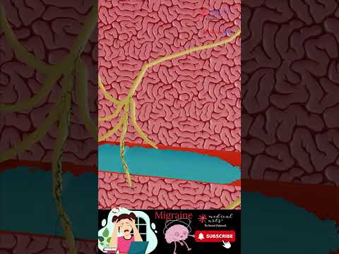 Tech Solutions for Headaches and Nosebleeds Uncovered