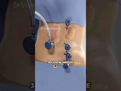 Revolutionizing Kidney Health with Advanced Pyeloplasty Techniques