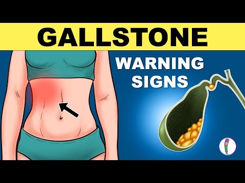 Unraveling the Tech Behind Gallstone Causes and Solutions