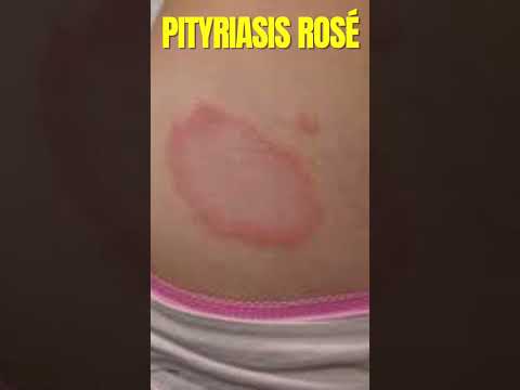 Christmas Tree Rash: Tech Solutions for Holiday Comfort