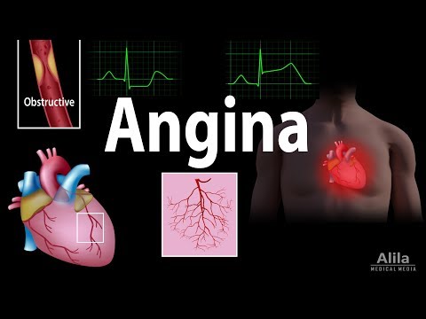 Managing Prinz Metal Angina with Smart Tech Solutions