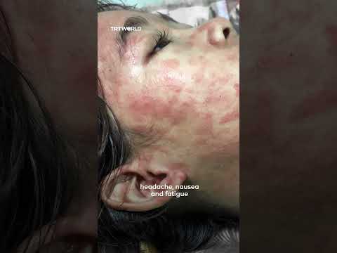 Chikungunya Fever: Innovation in Monitoring and Prevention