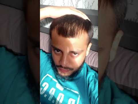 Revolutionary Tech Solutions for Lasting Baldness Rescue