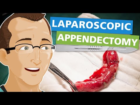 Revolutionizing Appendix Surgery with Innovative Tech